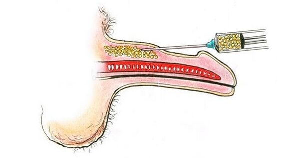 Hüaluroonhappe süstimine liikme tünnisse, et seda suurendada